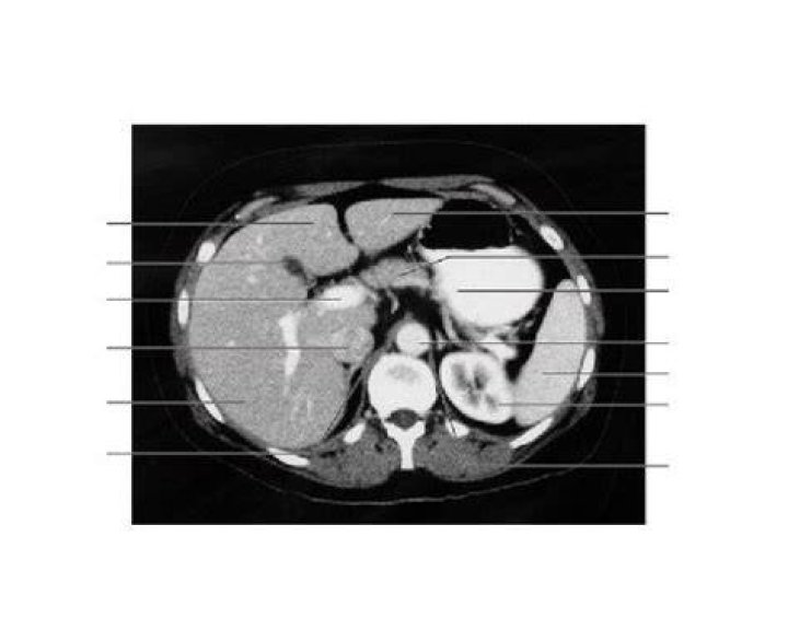 Abdomical CT
